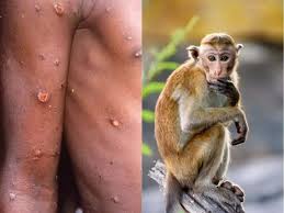 monkeypox disease